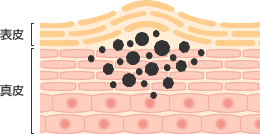 色素性母斑(しきそせいぼはん)(母斑細胞性母斑) 皮膚断面図