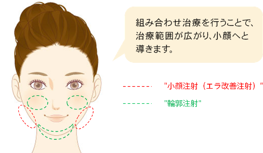 組み合わせ治療を行うことで、治療範囲が広がり、小顔効果へと導きます。　小顔注射（エラ改善注射）が効果的な範囲と輪郭注射が効果的な範囲