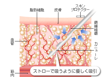 脂肪減少術