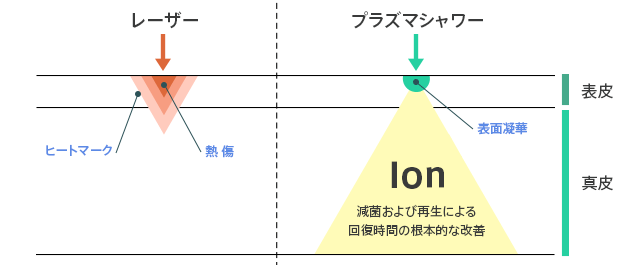 Ion 減菌および再生による回復時間の根本的な改善