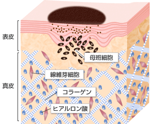 ほくろの原因 皮膚断面図