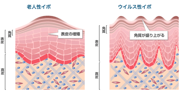 老人性イボ:表皮の増殖、ウィルス性イボ:角質が盛り上がる