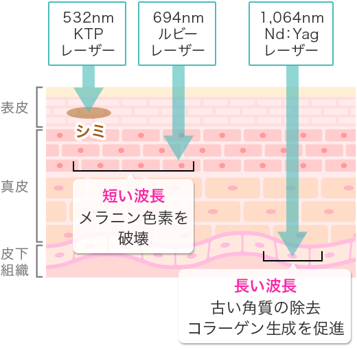 【短い波長 メラニン色素を破壊】532nm KTPレーザー、694nm ルビーレーザー　【長い波長 古い角質の除去 コラーゲン生成を促進】1,064nm Nd:Yagレーザー