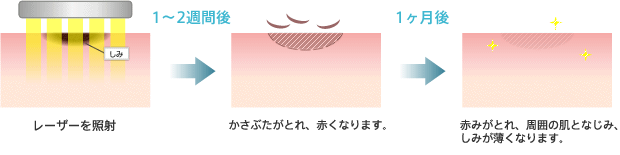 レーザーを照射 1～2週間後 かさぶたがとれ、赤くなります。 1ヶ月後 赤みがとれ、周囲の肌となじみ、しみが薄くなります。