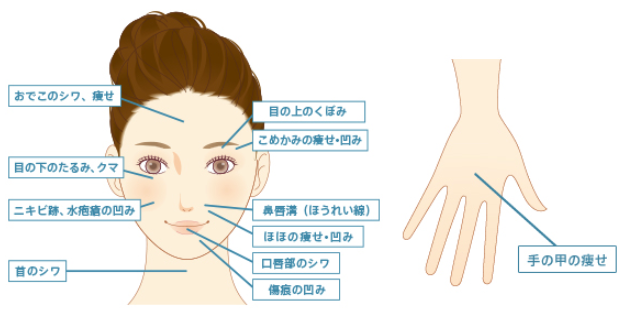 おでこのシワ・痩せ、目の上のくぼみ、こみかめの痩せ・凹み、目の下のたるみ・クマ、ニキビ跡、水疱瘡の凹み、鼻唇溝（ほうれい線）、ほほの痩せ・凹み、口唇部のシワ、傷跡の凹み、首のシワ、手の甲の痩せ