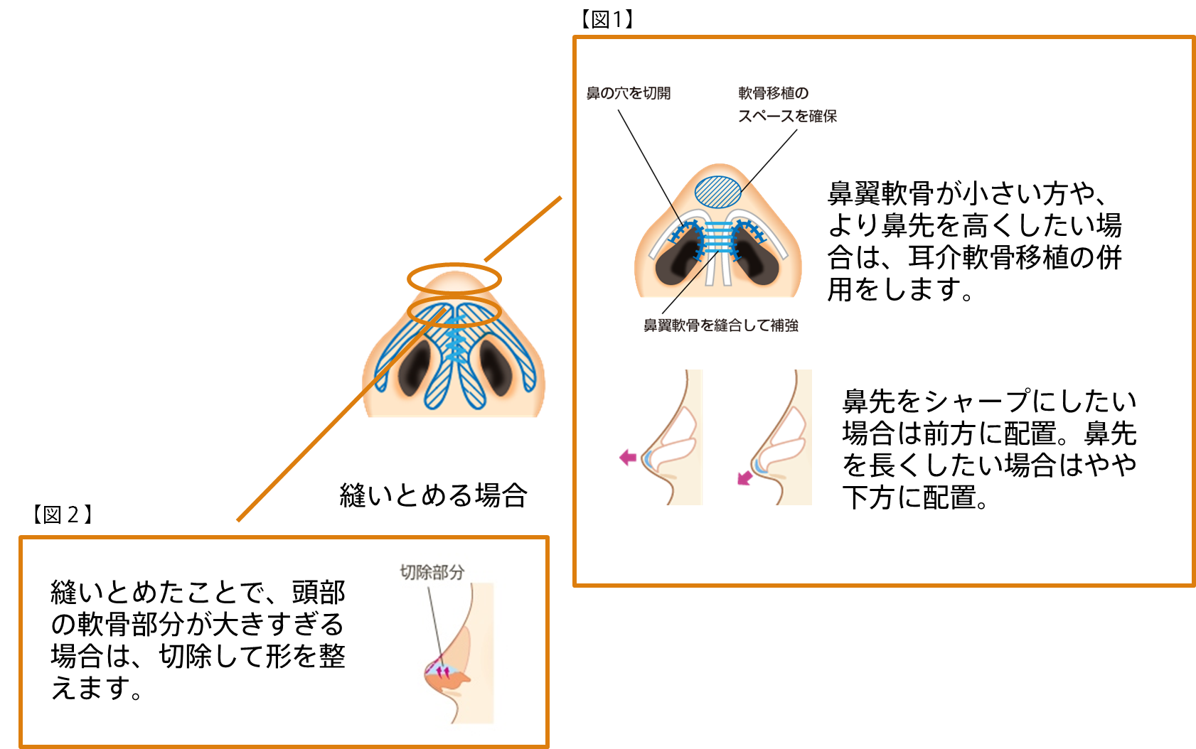 【図1】尾翼軟骨が小さい方や、より鼻先を高くしたい場合は、次回軟骨移植の併用をします。鼻先をシャープにしたい場合は前方に配置。鼻先を長くしたい場合はやや下方に配置。 【図2】縫いとめたことで、頭部の軟骨部分が大きすぎる場合は、切除して形を整えます。