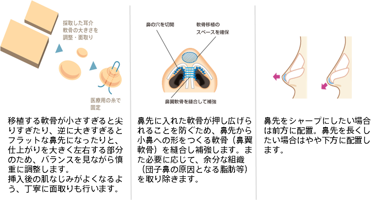 移植する軟骨が小さすぎると尖りすぎたり、逆に大きすぎるとフラットな鼻先になったりと、仕上がりを大きく左右する部分のため、バランスを見ながら慎重に調整します。挿入後の肌なじみがよくなるよう、丁寧に面取りも行います。 鼻先に入れた軟骨が押し広げられることを防ぐため、鼻先から 小鼻への形をつくる軟骨 (鼻翼 軟骨) を縫合し補強します。また必要に応じて、余分な組織 (団子鼻の原因となる脂肪等) を取り除きます。 鼻先をシャープにしたい場合は前方に配置。鼻先を長くしたい場合はやや下方に配置します。