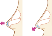 軟骨を移植、縫合