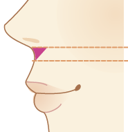 当院の鼻下短縮術の特長