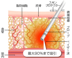 最大90%まで吸引