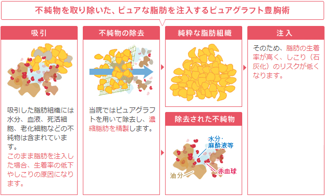 不純物を取り除いた、ピュアな脂肪を注入するピュアグラフト豊胸術