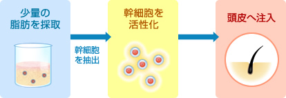 少量の脂肪を採取→幹細胞を抽出→幹細胞を活性化→頭皮へ注入