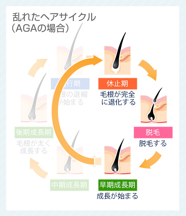 乱れたヘアサイクル（AGAの場合） 早期成長期 成長が始まる 休止期 毛根が完全に退化する 脱毛 脱毛する