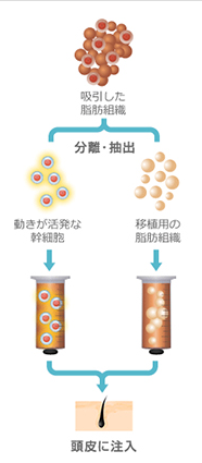 吸引した脂肪組織 分離・抽出 動きが活発な幹細胞 移植用の脂肪組織 頭皮に注入