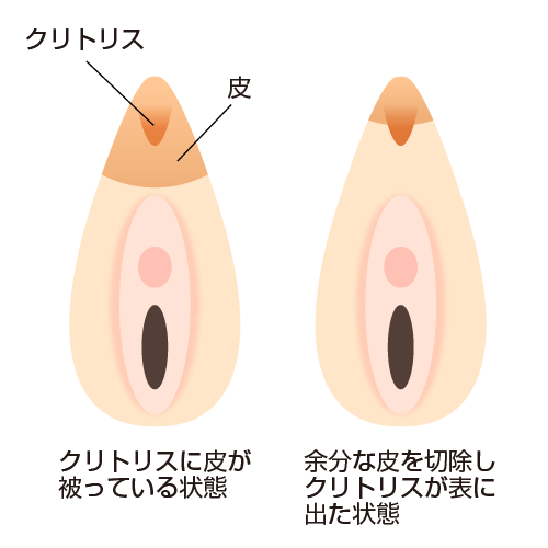 クリトリスに皮が被っている状態　余分な皮を切除しクリトリスが表に出た状態