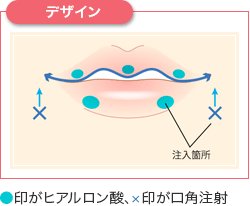 デザイン ●印がヒアルロン酸、×印が口角注射