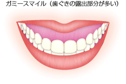 ガミースマイル（歯ぐきの露出部分が多い）