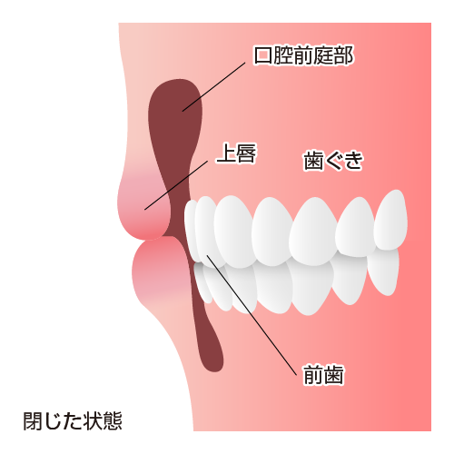 口元を横から見た断面図：閉じた状態