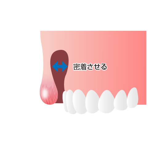 上唇の内側と歯ぐきの粘膜を摘除