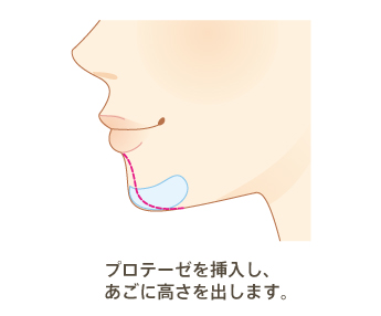 プロテーゼを挿入し、あごに高さを出します。