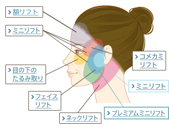 額リフト ミニリフト 目の下のたるみ取り フェイスリフト ネックリフト コメカミリフト ミニリフト プレミアムミニリフト