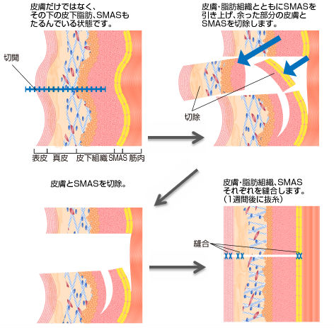 皮膚だけではなく、その下の皮下脂肪、SMASもたるんでいる状態です。 → 皮膚・脂肪組織とともにSMASを引き上げ、余った部分の皮膚とSMASを切除します。 → 皮膚とSMASを切除。 → 皮膚・脂肪組織、SMASそれぞれを縫合します。(1週間後に抜糸)