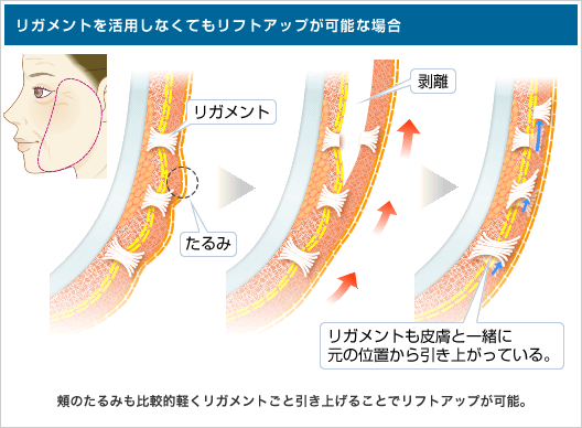 リガメントを活用しなくてもリフトアップが可能な場合