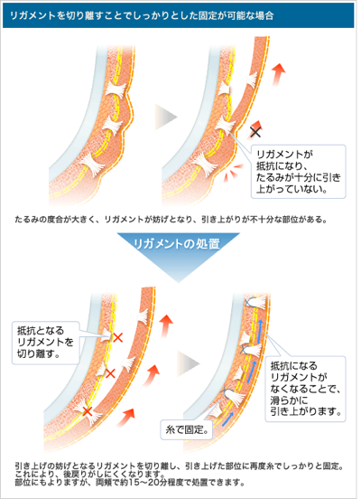 リガメントを切り離すことでしっかりとした固定が可能な場合