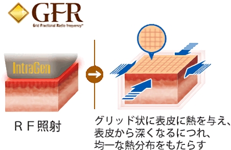GFR RF照射 グリッド状に表皮に熱を与え、表皮から深くなるにつれ、均一な熱分布をもたらす