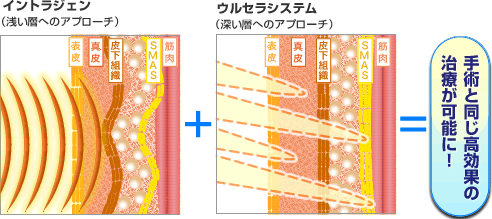 イントラジェン（浅い層へのアプローチ） + ウルセラシステム（深い層へのアプローチ） ＝ 手術と同じ高効果の治療が可能に！