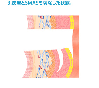 3.皮膚とSMASを切除した状態。