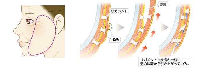 リガメントを活用しなくても処置ができる場合