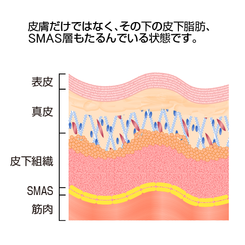 皮膚だけではなく、その下の皮下脂肪、SMAS層もたるんでいる状態です。