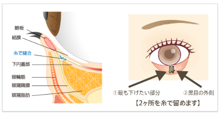 埋没法の場合