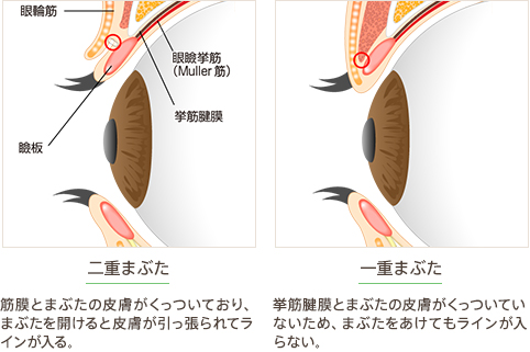 二重まぶた 筋膜とまぶたの皮膚がくっついており、まぶたを開けると皮膚が引っ張られてラインが入る。 一重まぶた 挙筋腱膜とまぶたの皮膚がくっついていないため、まぶたをあけてもラインが入らない。