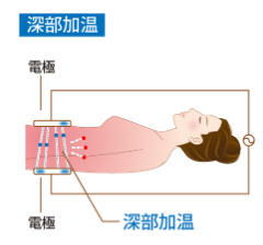 深部加温