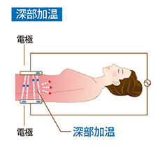 深部加温