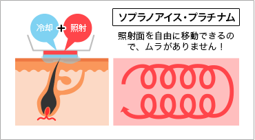 ソプラノアイス・プラチナム,照射面を自由に移動できるので、ムラはほとんどありません！