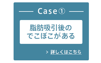 Case① 脂肪吸引後のでこぼこがある 詳しくはこちら