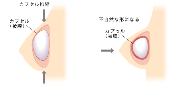 カプセル拘縮について