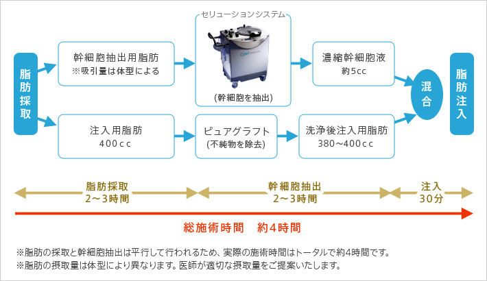 例 片側乳房に200ccずつ脂肪を注入する場合 ※脂肪の採取と幹細胞抽出は平行して行われるため、実際の施術時間はトータルで約4時間です。 ※脂肪の採取量は体型により異なります。医師が適切な摂取量をご提案します。