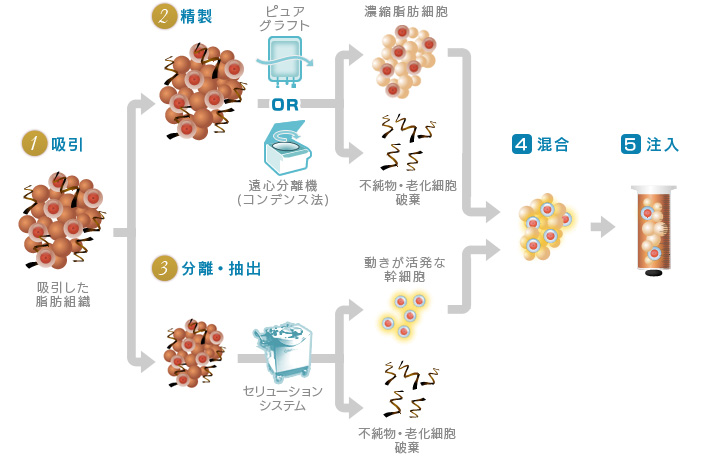 脂肪と幹細胞を分離することで、幹細胞を活性化