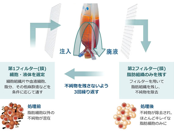 ピュアグラフト：注入→廃液