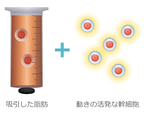 吸引した脂肪 + 動きの活発な幹細胞