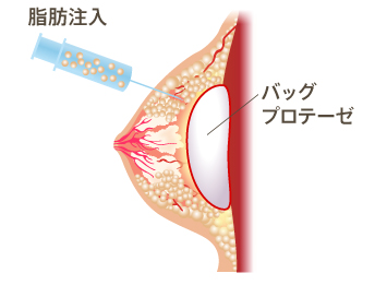 脂肪注入、バックプロテーゼ