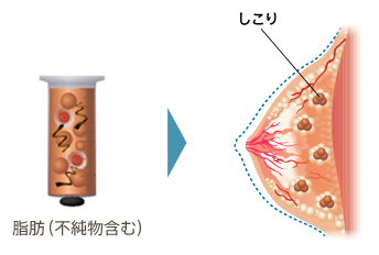 脂肪の生着率の効果を高めるためには、不純物の除去＆幹細胞が重要