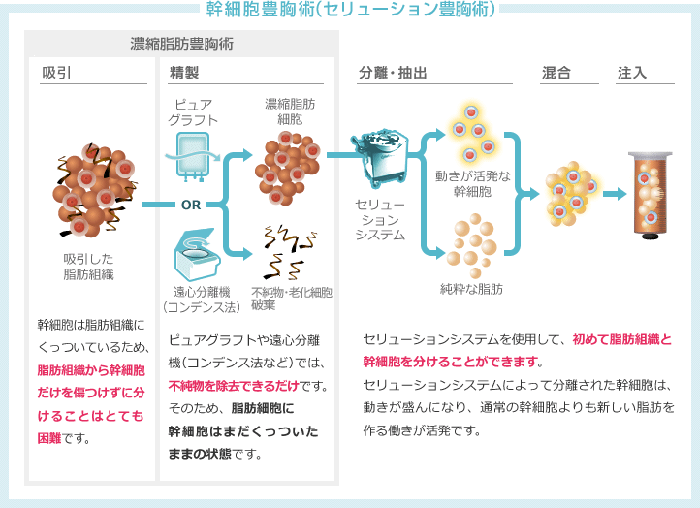 “幹細胞豊胸術”でより生着率の効果を高める！