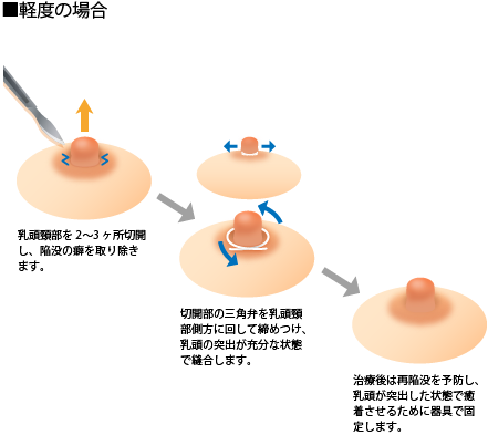 ■軽度の場合　乳頭頸部を2～3ヶ所切開し、陥没の癖を取り除きます。→切開部の三角弁を乳頭頸部方向に回して締め付け、乳頭の突出が充分な状態で縫合します。→治療後は再陥没を予防し、乳頭が突出した状態で癒着させるために器具で固定します。