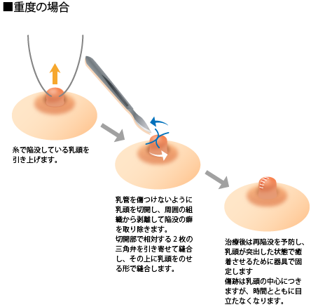 ■重度の場合 糸で陥没している乳頭を引き上げます。 乳管を傷つけないように乳頭を切開し、周囲の組から剥離して陥没の癖を取り除きます。切開部で相対する2枚の三角弁を引き寄せて縫合し、その上に乳頭をのせる形で縫合します。 治療後は再陥没を予防し、乳頭が突出した状態で癒着させるために器具で固定します傷跡は乳頭の中心につきますが、時間とともに目立たなくなります。