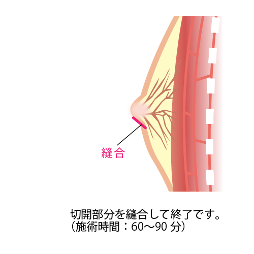 切開部分を縫合して終了です。（施術時間：60～90分）